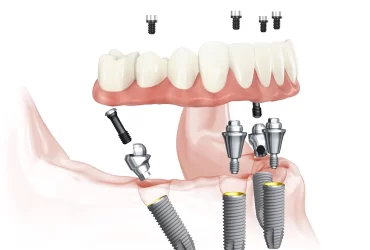 All-On-4 Implant Supported Dentures