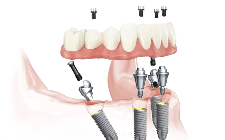 All-on-4-dental-implant