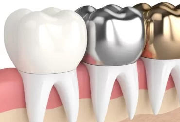 Dental Crowns