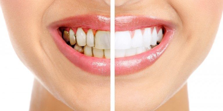 Limit Your Intake Of These Substances That Cause Tooth Stains