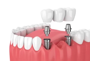 dental bridges