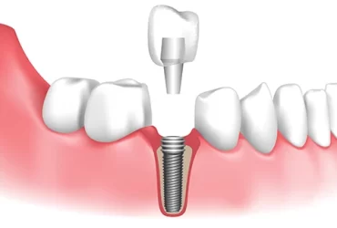 Dental Implant Restorations