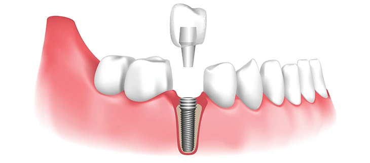 dental-implant