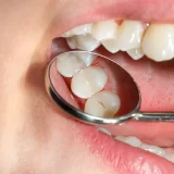 dental-sealants