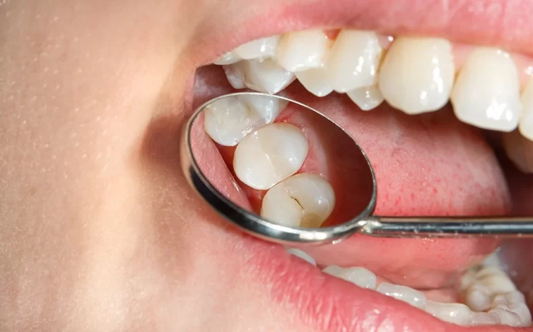 dental-sealants