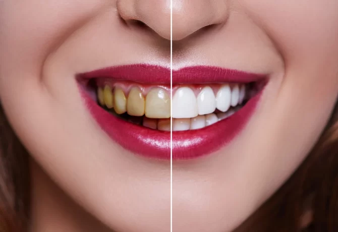 dental-veneers