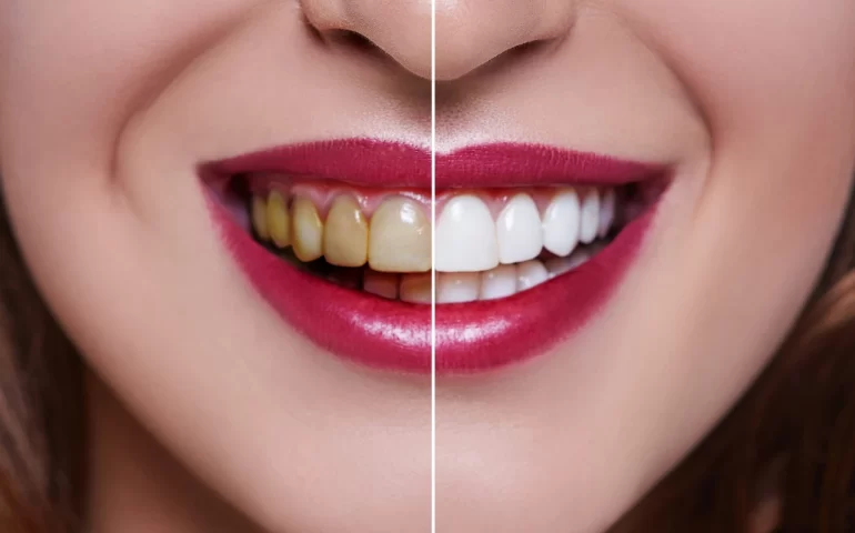 dental-veneers