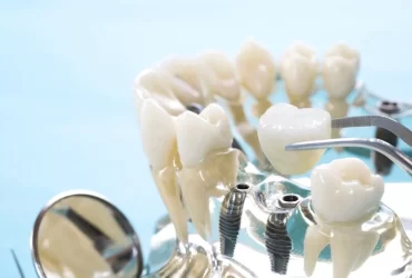 dental bridges