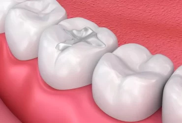 Fillings 3D