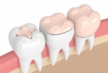 dental-inlay-onlay