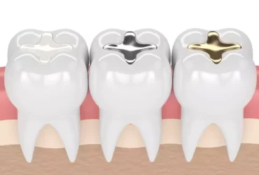 Dental inlay